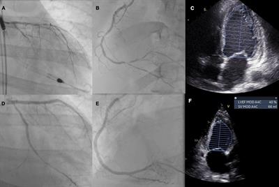 Case Report: do heart transplant candidates benefit from mechanically supported revascularization?